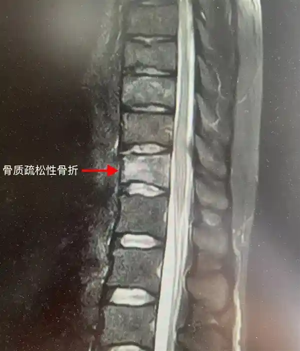 25岁女孩咖啡成瘾，腰部骨折揭开骨质疏松真相